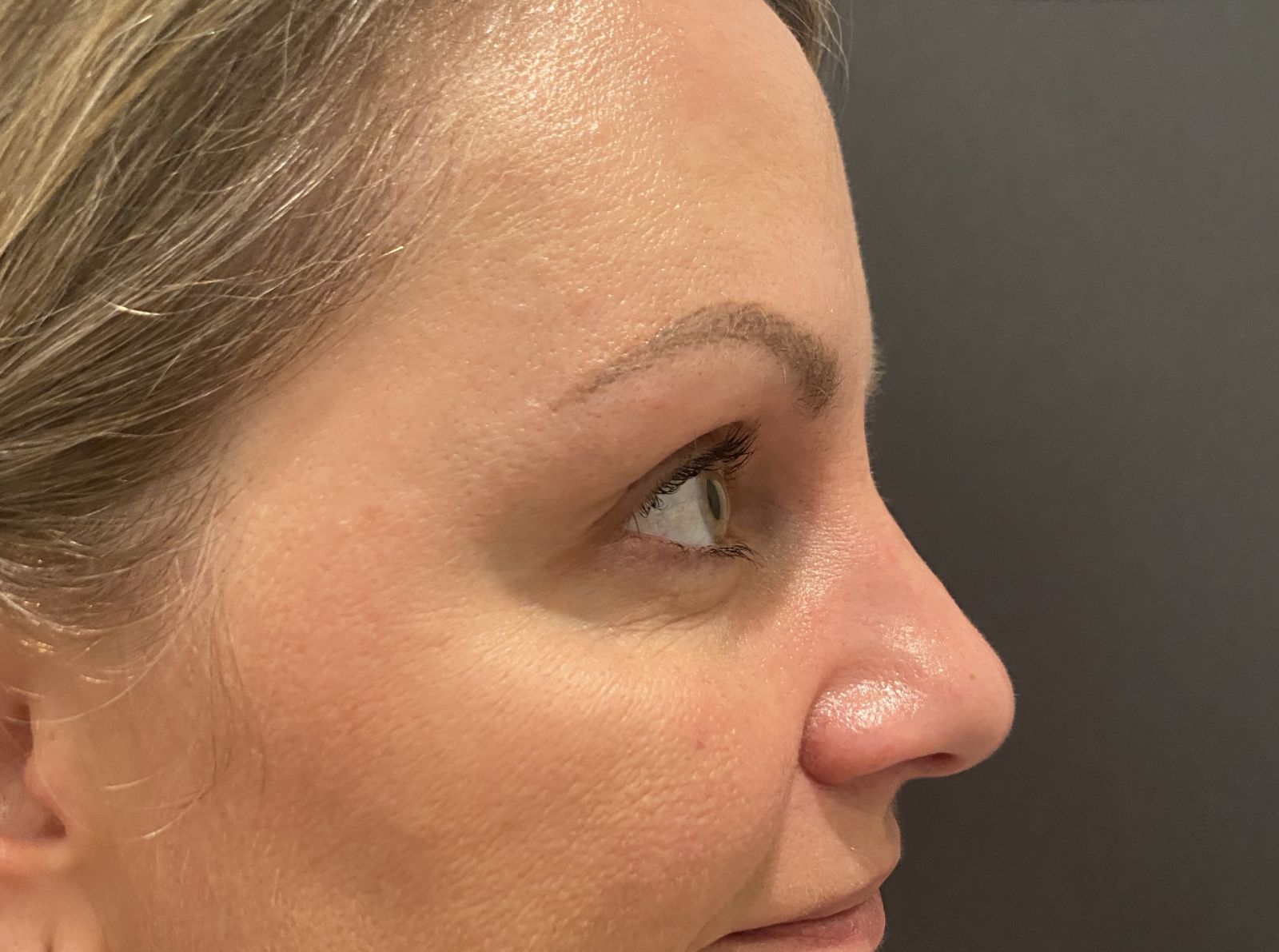 After Crows Feet Botox treatment