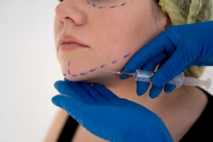 Masseter Botox in Guildford